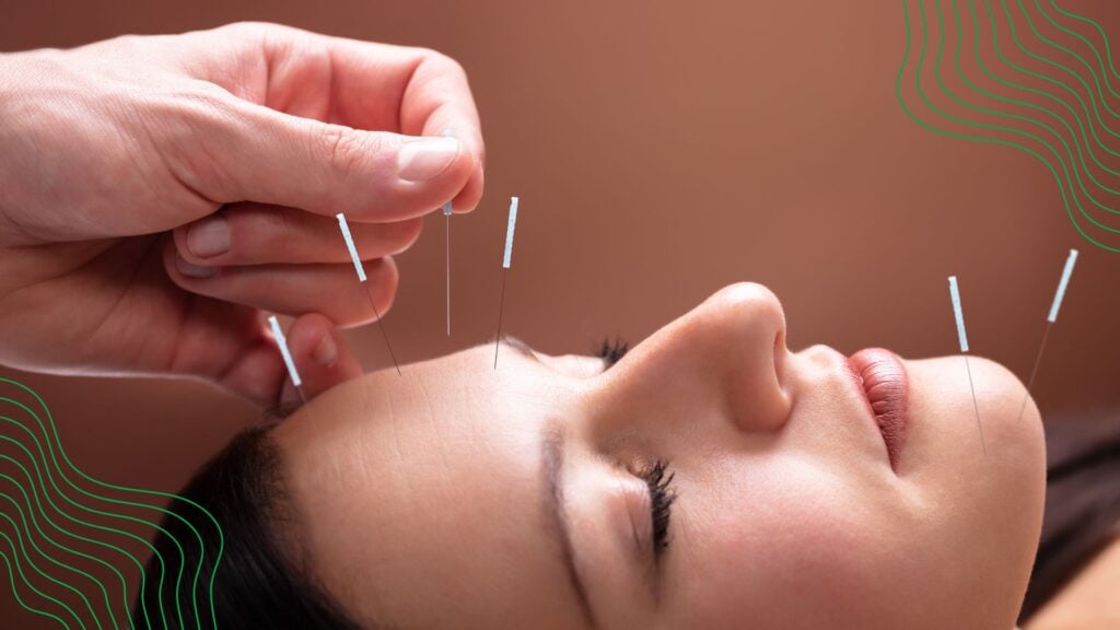A woman receiving facial acupuncture