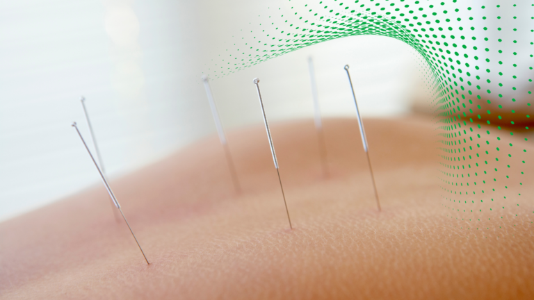 Acupuncture needs poking into a persons back